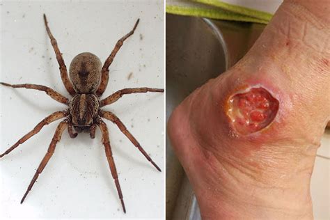 Keep firewood at least 20 feet away from your home. . Recluse spider bite pictures